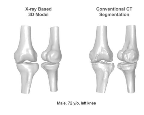 XPlan’s high-fidelity X-ray based 3D knee model, compared to a conventional CT based model of the same patient.